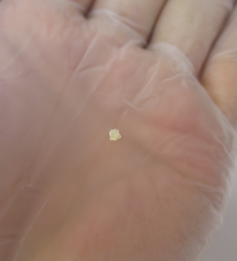 IMG_5279-魚の目・鶏眼