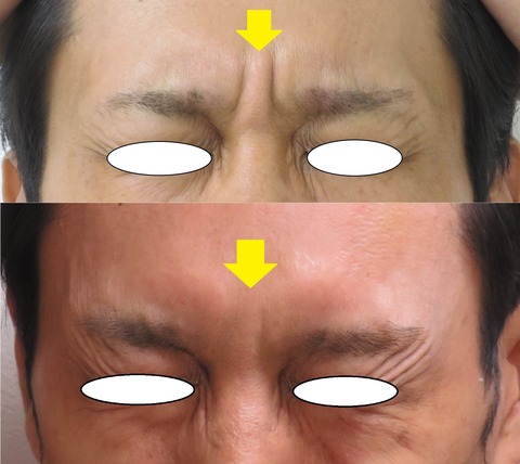 眉間ボトックスＢ＆Ａ