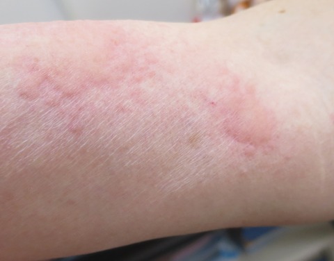 IMG_2796-t蕁麻疹