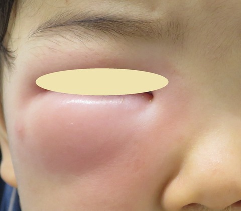 IMG_6971-tm虫刺され