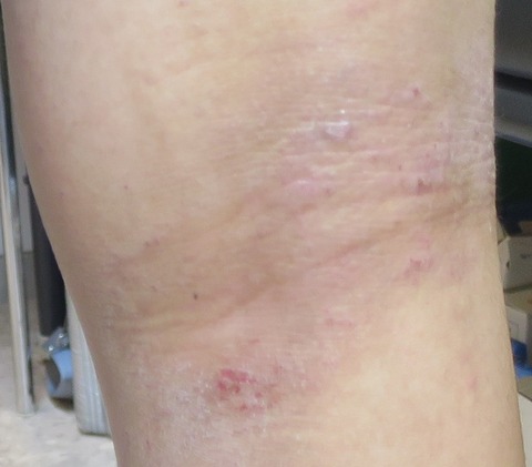 IMG_4390-アトピー性皮膚炎-1000