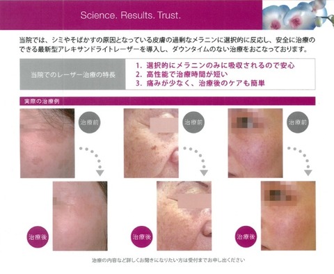 レーザーフェイシャルP下