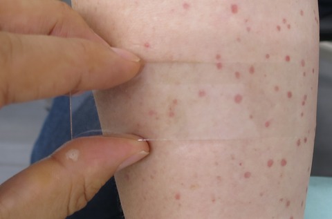 IMG_8679紫斑before