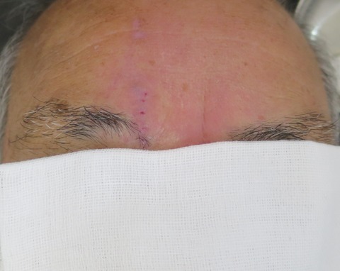 IMG_0087-m-d10抜糸