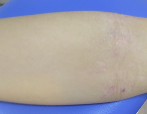 IMG_4388-アトピー性皮膚炎-1000