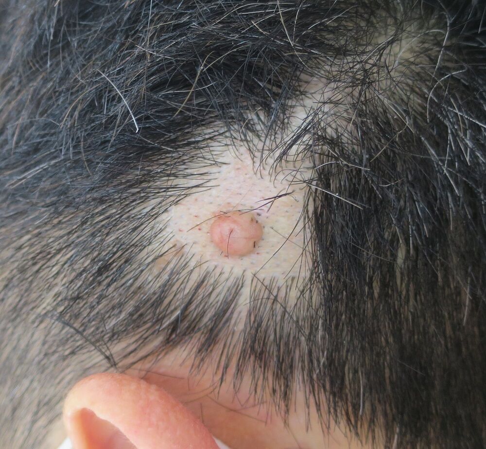 頭皮のデキモノの手術です 戸越皮膚科クリニックのブログ