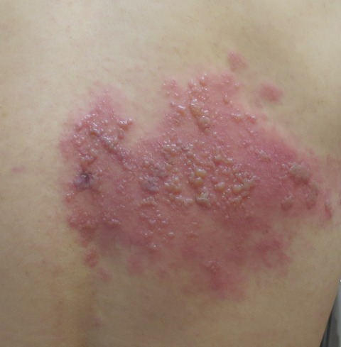 IMG_5089-帯状疱疹背中の水疱