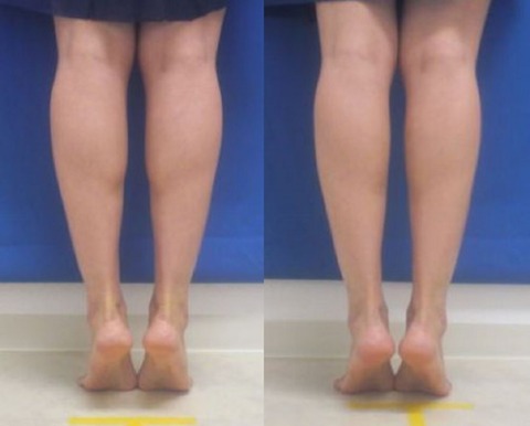 ボトックスふくらはぎOkaまとめ1000