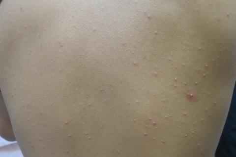 IMG_6375-t背中ニキビ2