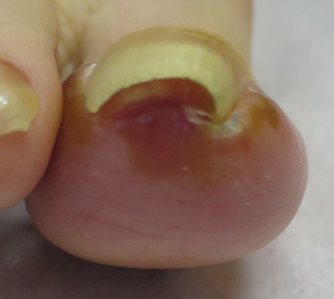 IMG_1051-t-d0巻き爪