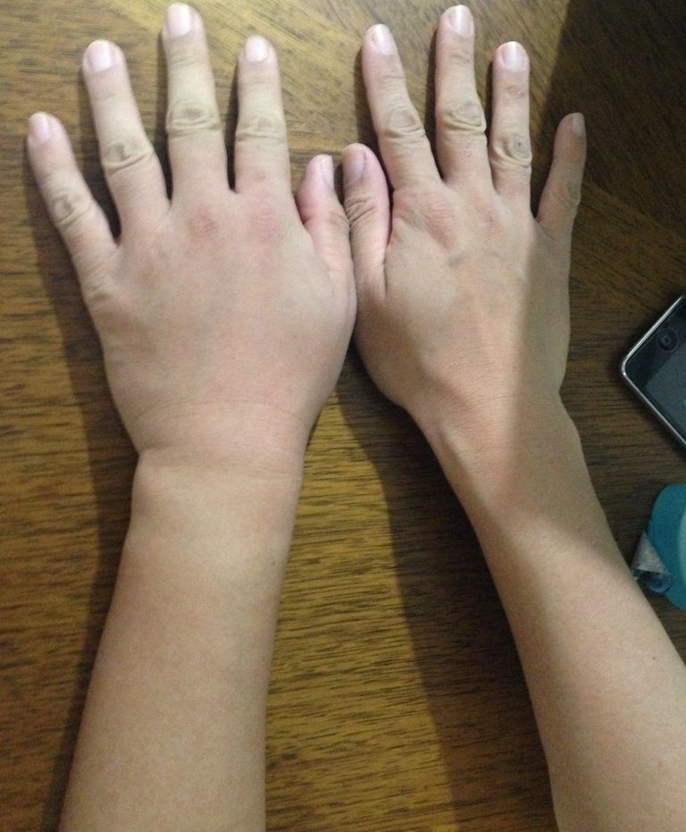 カリング 上院 準備した 左手 むくみ Kowa Unsou Jp