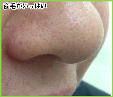 顔の産毛ケアしてますか 脱毛は安心安全確実な医療レーザー脱毛に限ります トキコレ 顔の産毛ケアしてますか 脱毛は安心安全確実な医療レーザー脱毛に限ります トキコレ