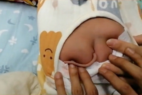 【画像】中国で生まれた赤ちゃん、なんと！お尻から10センチ尻尾が生えていた！