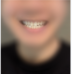 ホワイトニング