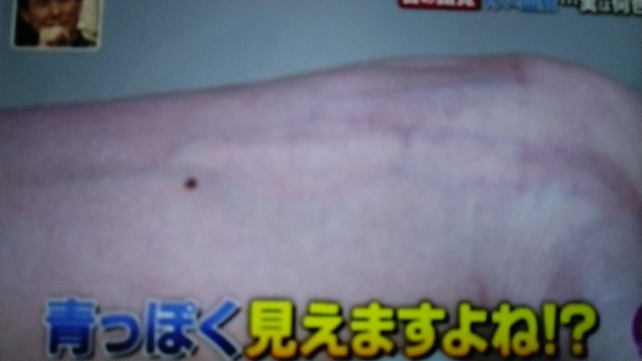 血管が青に見えるのは 目の錯覚 蜻蛉の一人言 血管が青に見えるのは 目の錯覚 蜻蛉の一人言