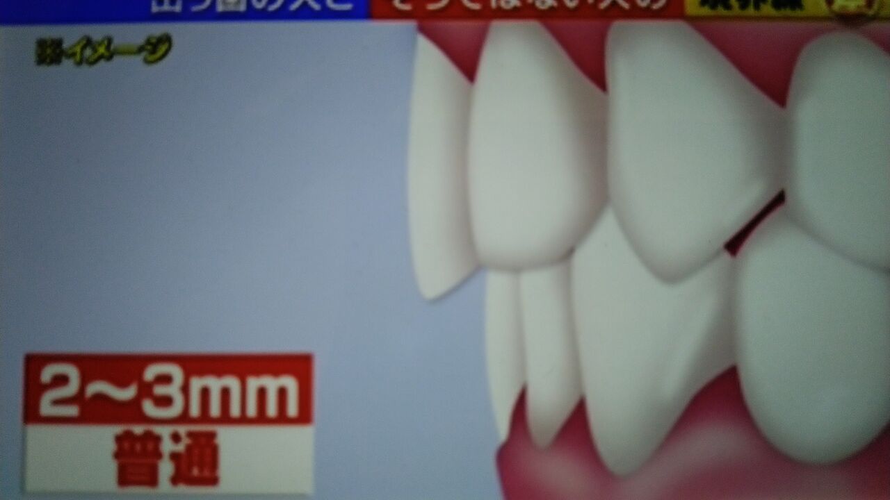 出っ歯の人と出っ歯ではない人の境界線 蜻蛉の一人言