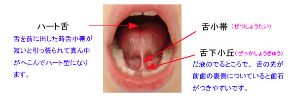 舌小帯を切る手術はこんなに簡単 舌小帯のはなし