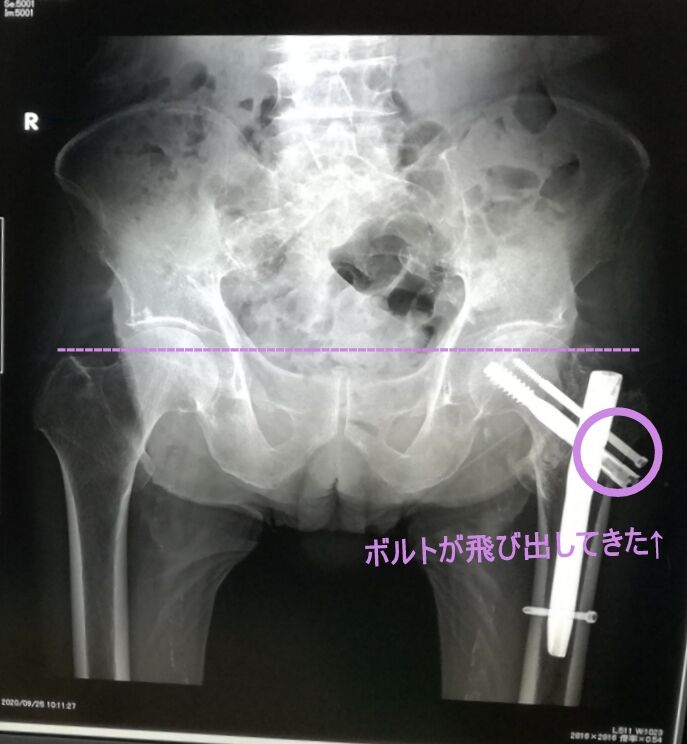 左大腿骨転子部骨折手術直後と5か月後のレントゲン写真 90歳父の認知症進行日記 左大腿骨転子部骨折手術直後と5か月後のレントゲン写真 90歳父の認知症進行日記