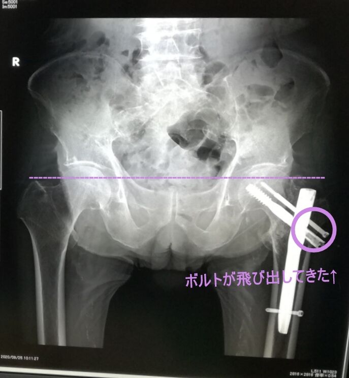 左大腿骨転子部骨折手術直後と５か月後のレントゲン写真 90歳父の認知症進行日記