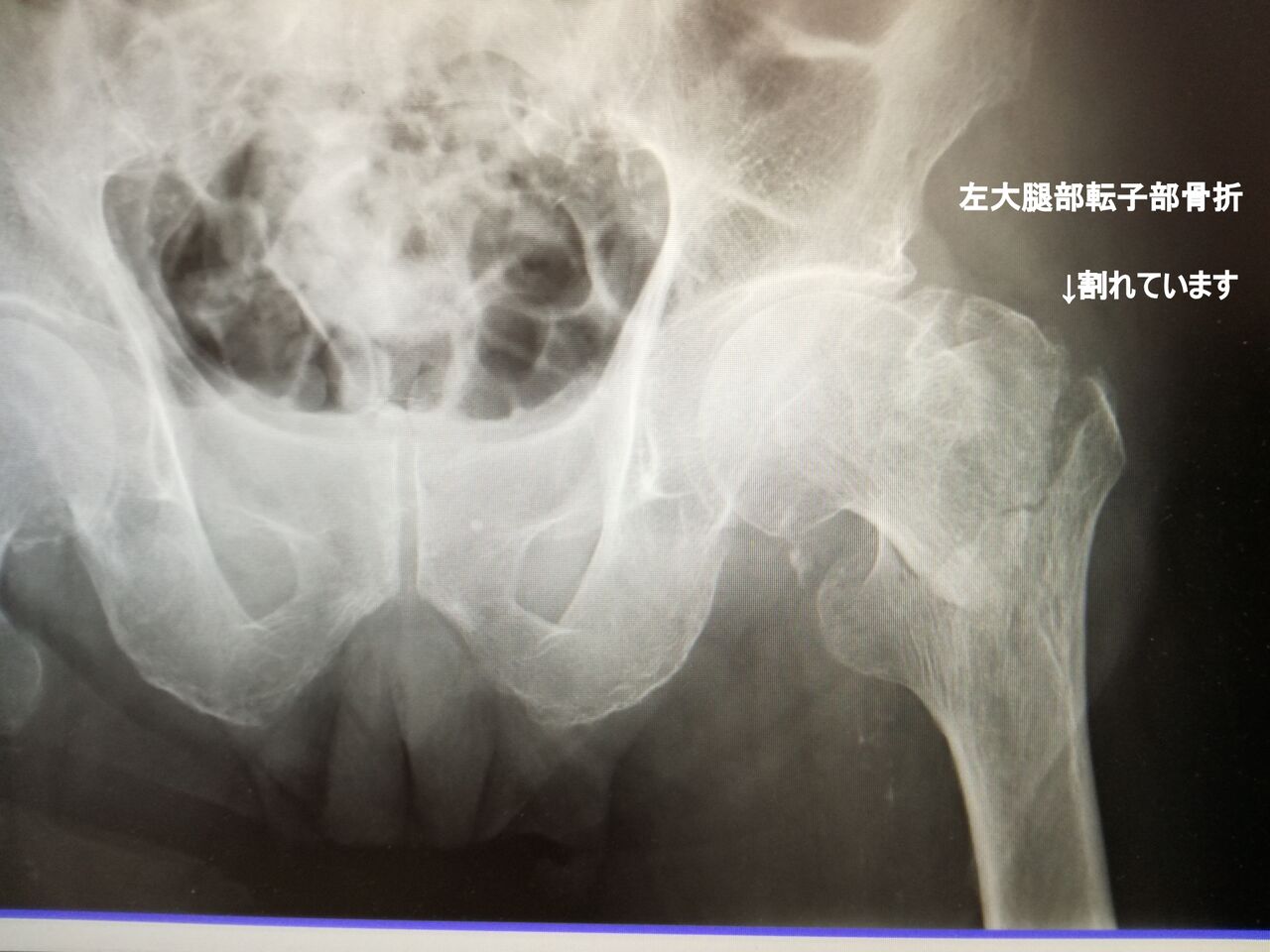 左大腿骨転子部骨折手術直後と５か月後のレントゲン写真 90歳父の認知症進行日記