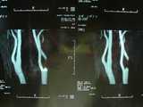 MRI