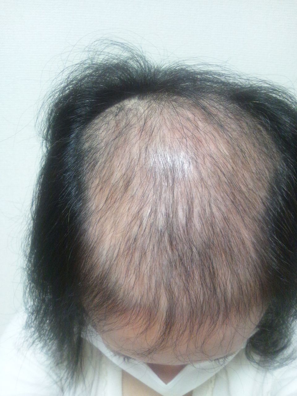 9月6日 本以上 経過写真 抜毛症を記録するブログ
