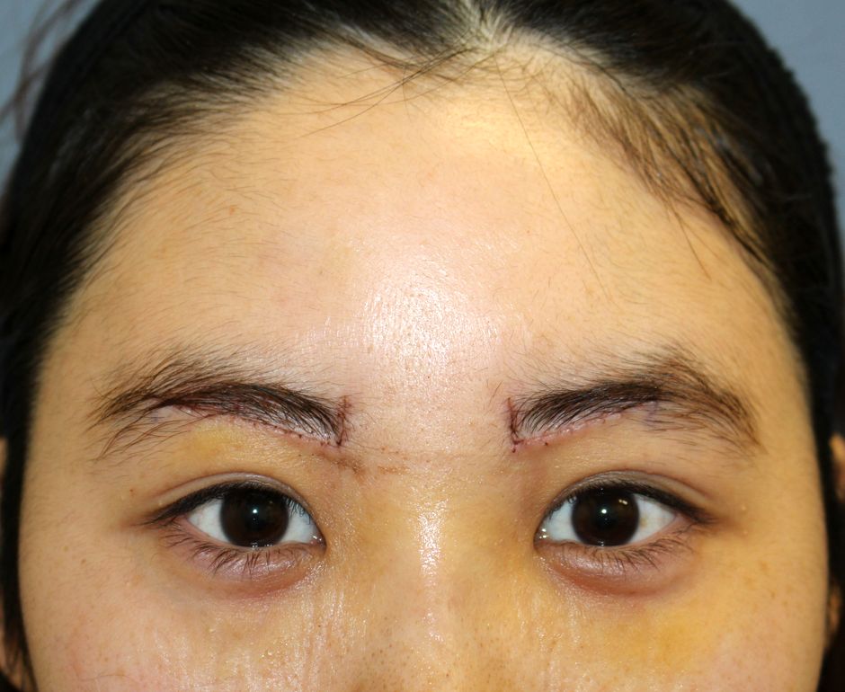 ｏ 上眼瞼リフト 眉毛下切開 手術後1週間の経過写真 美容外科医 高野敏郎のblog