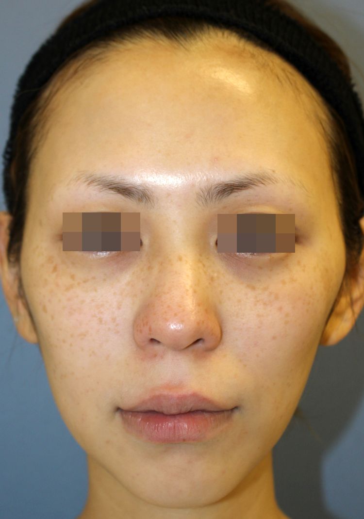 A ライムライト 光治療 Ipl 1回照射後の経過写真 美容外科医 高野敏郎のblog