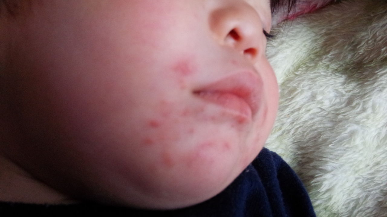 1歳の口周りの湿疹 アミロイド苔癬治療