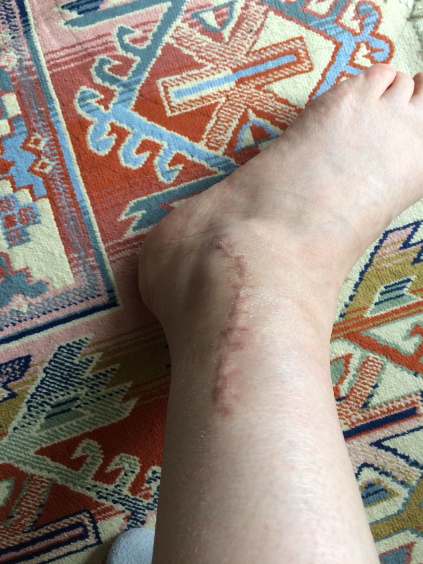 足関節骨折後苦節一年一か月 ヤッホイ 正座が出来た Tapitapiの足骨折日記