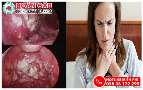 nguyen-nhan-va-phuong-phap-dieu-tri-viem-amidan-hoc-mu