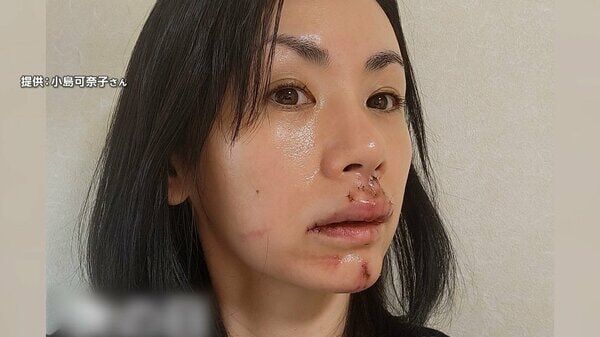 『小島可奈子』犬に顔を噛まれ30針も縫う大けが