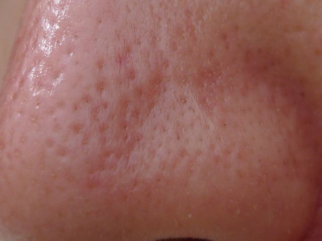 トレチノインによる2度目のいちご鼻治療結果まとめ トレチノイン ハイドロキノンいちご鼻使用体験記