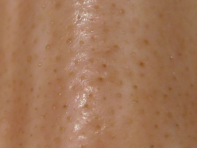 トレチノインによるいちご鼻の角栓や毛穴 凹凸の治療を開始 トレチノイン ハイドロキノンいちご鼻使用体験記 トレチノインによるいちご鼻の角栓や毛穴 凹凸の治療を開始 トレチノイン ハイドロキノンいちご鼻使用体験記