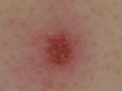 シミがほぼ消えた トレチノイン ハイドロキノンいちご鼻使用体験記