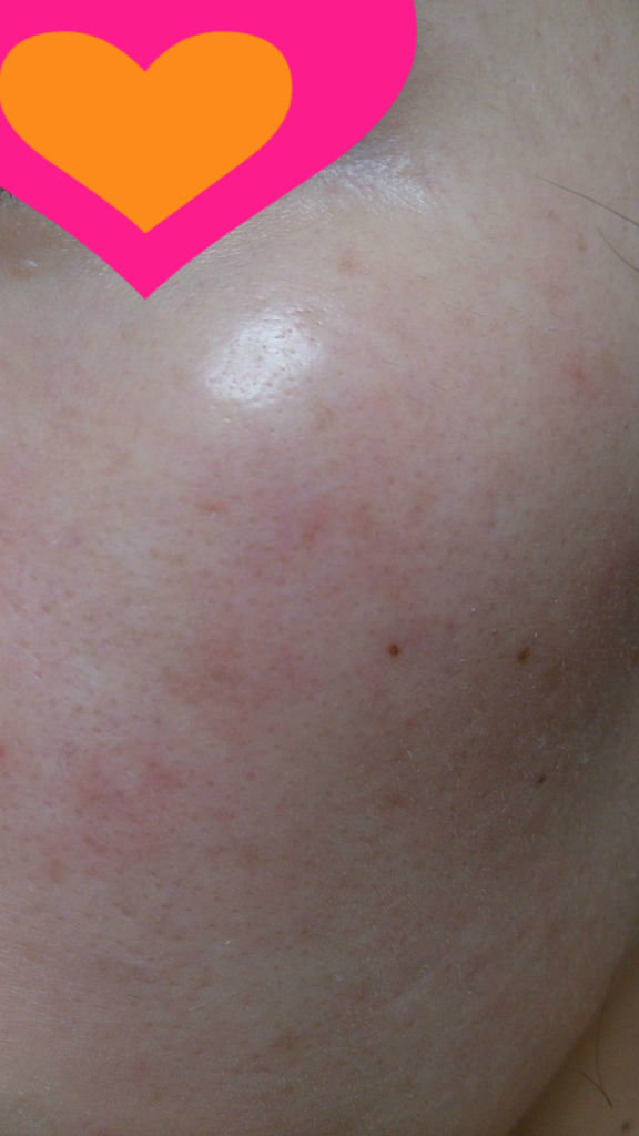 トレチノイン ハイドロキノン 50日目 56日目 8週間目 トレチノイン ハイドロキノン経過写真ブログ