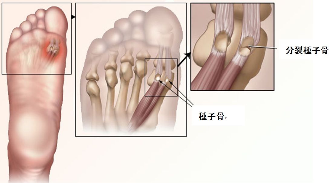 障害 種子 骨
