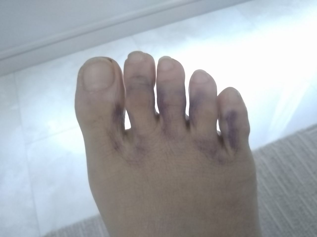 足首骨折したblog