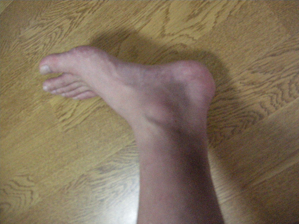 たら 足首 が 痛い 朝起き