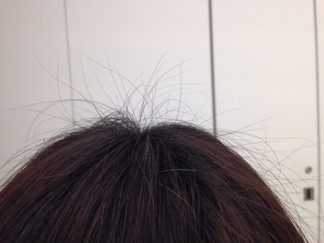 これで髪が増えました ワタシのつむじ オレのつむじ