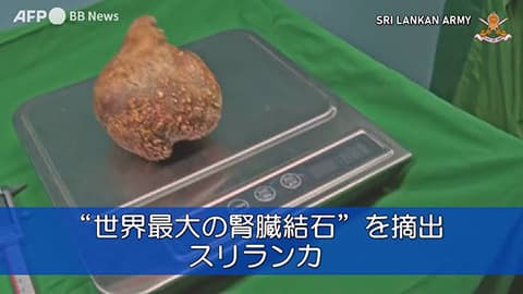 世界最大の腎臓結石