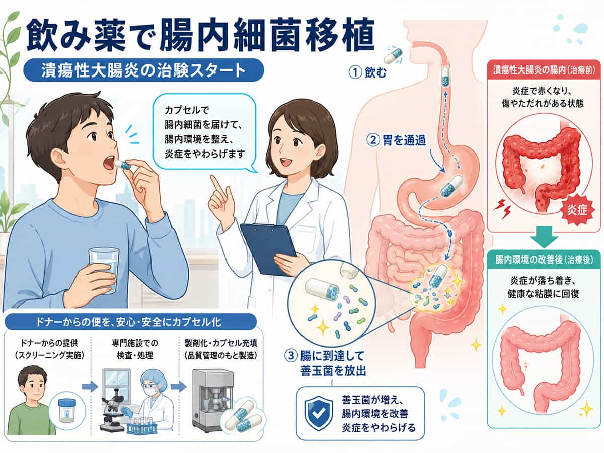 飲み薬による腸内細菌移植で潰瘍性大腸炎の治験を行うイメージ