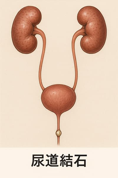尿道結石経験者集まれー！