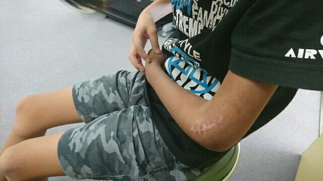 骨折 抜釘手術 さとぼうし 骨折 抜釘手術 さとぼうし