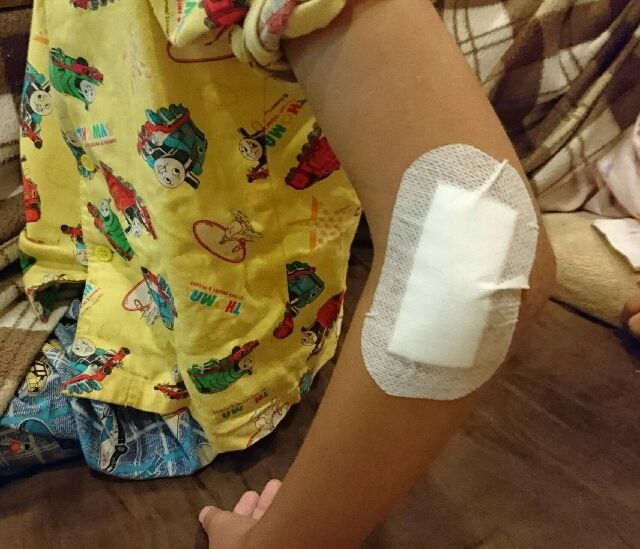 骨折 抜釘手術 さとぼうし