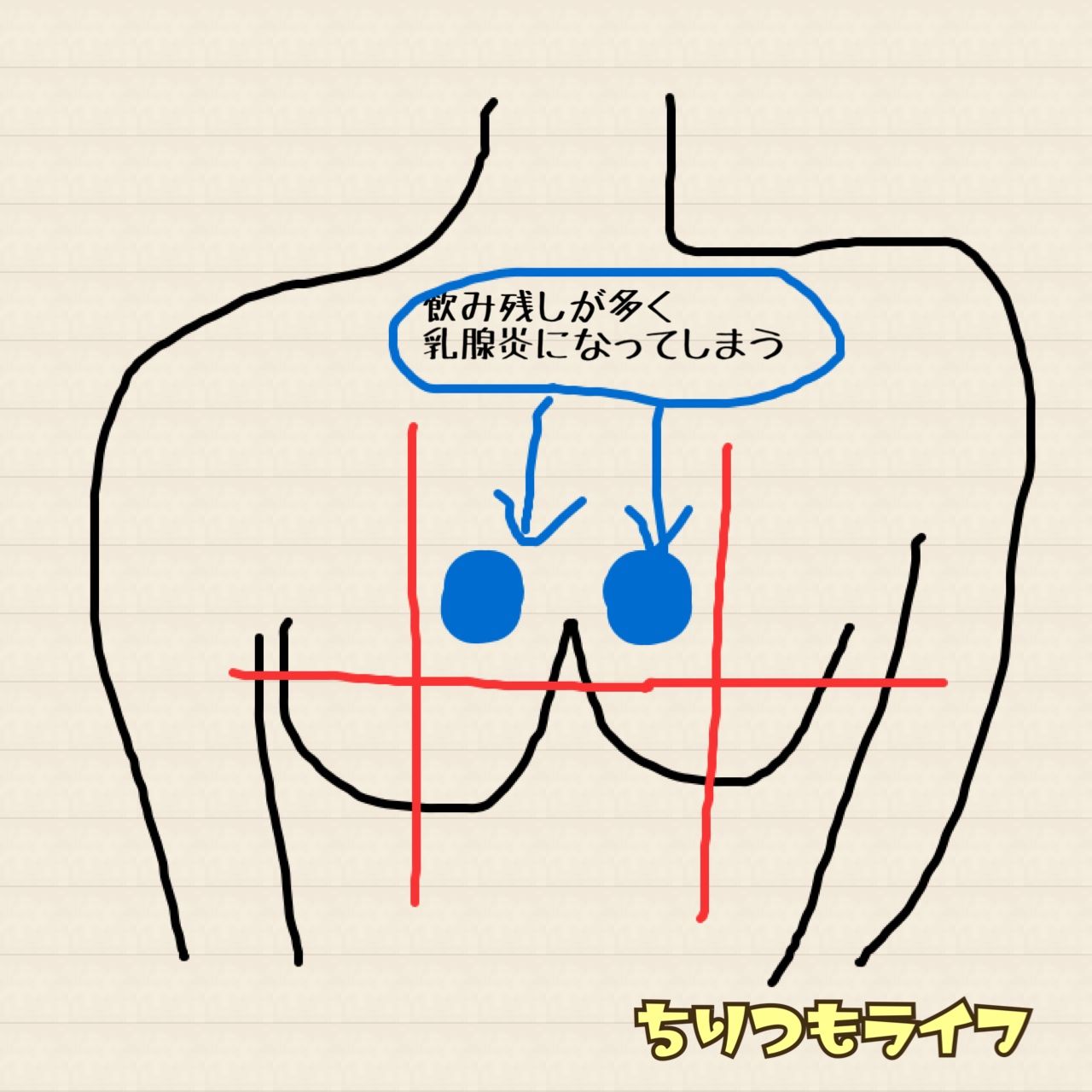 乳腺 炎 なり かけ 乳腺 炎 なり かけ