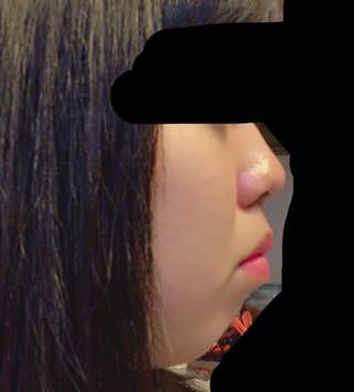 画像 アデノイドの横顔キモすぎwww ていへん 画像 アデノイドの横顔キモすぎwww ていへん