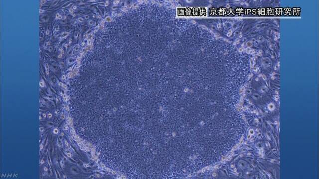 髪と頭皮はまだか ｉｐｓ細胞から作った目の角膜移植 条件付きで了承 ついっちゃが