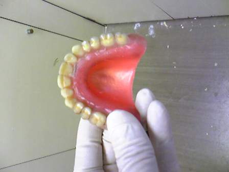 コピーデンチャーの作り方 : moriura dental clinic 予防歯科ブログ