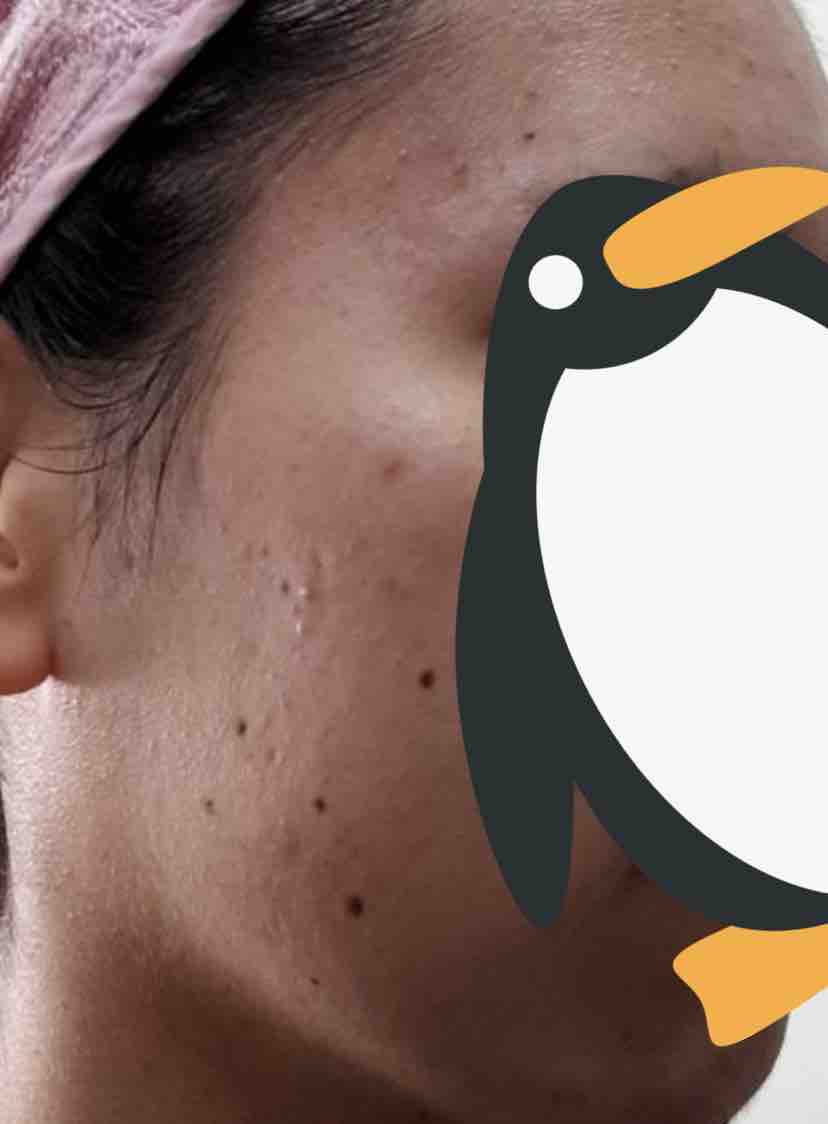 韓国でほくろ シミ除去してきた 顔のほくろ取り放題 アフターケア付き で2万8千円 Olみやこの毎日